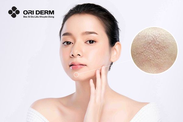 Mụn Ẩn Dưới Cằm: Nguyên Nhân Và Cách Trị Mụn Ẩn Ở Cằm
