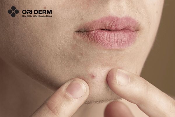 Những nguyên nhân bị mụn ẩn ở cằm