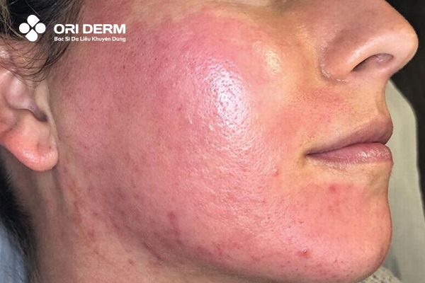 Nhược điểm của phương pháp lăn kim cải thiện sẹo rỗ