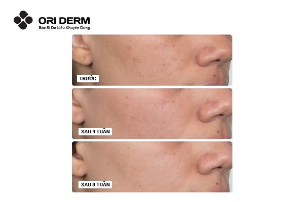 Niacinamide có trị thâm không?