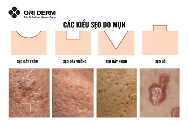 Sẹo mụn là gì? Các dạng sẹo mụn phổ biến