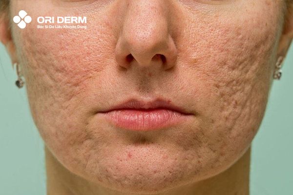 Trị sẹo rỗ bằng nghệ tươi có hiệu quả không?