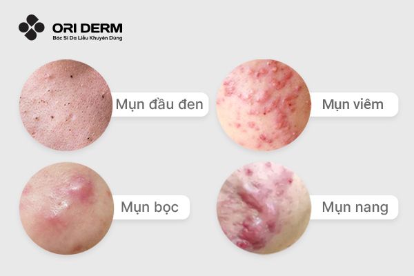 Các loại mụn thường gặp ở quai hàm