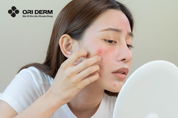 10 Loại Thuốc Gom Cồi Mụn Hiệu Quả Được Bác Sĩ Khuyên Dùng