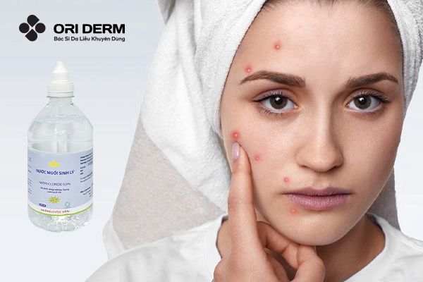 Dung dịch nước muối sinh lý có trị mụn được không?
