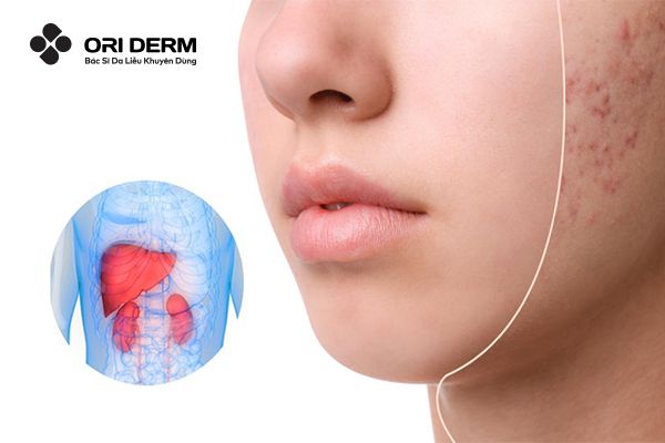 Mối liên quan giữa gan và việc nổi mụn