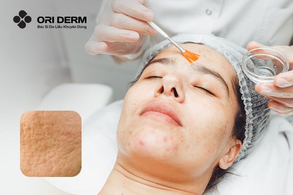 Peel Da Có Trị Sẹo Rỗ Được Không? Lợi Ích Và Lưu Ý Cần Biết