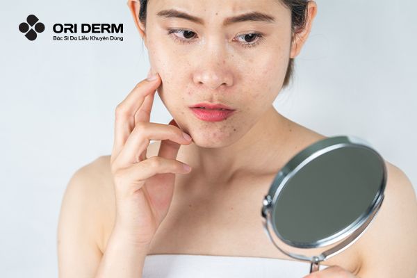 Mụn Nội Tiết Là Gì? Cách Nhận Biết Và Phương Pháp Trị Mụn Chuẩn Y Khoa