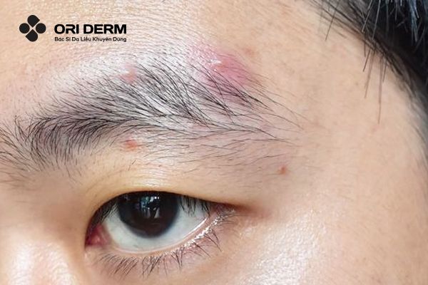 Các loại mụn phổ biến thường xuất hiện ở vùng lông mày