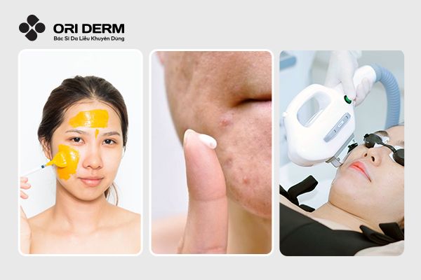 Các phương pháp trị mụn ở quai hàm hiệu quả