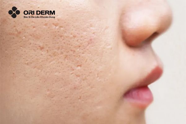 Peel da có trị sẹo rỗ được không?