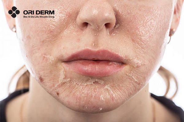 Cách trị mụn viêm ở mũi bằng peel da