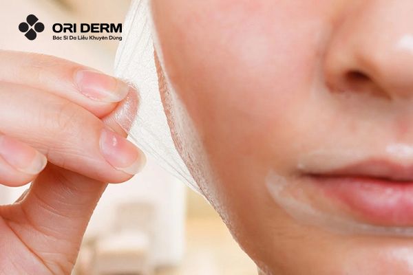 Trị mụn viêm đỏ không nhân bằng cách peel da hóa học