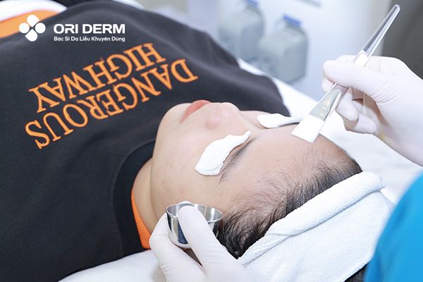 Peel da trị mụn viêm mủ