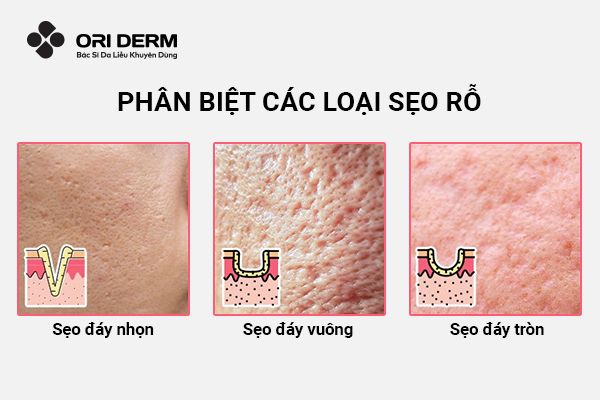 Phân biệt các loại sẹo rỗ