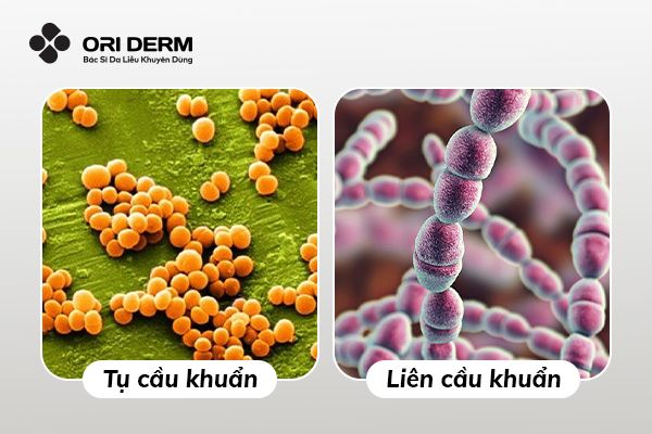 Phân loại các viêm da có mủ thường gặp