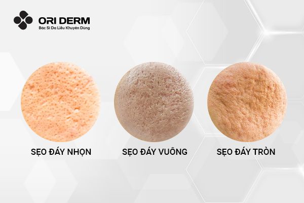 Phân loại sẹo lõm