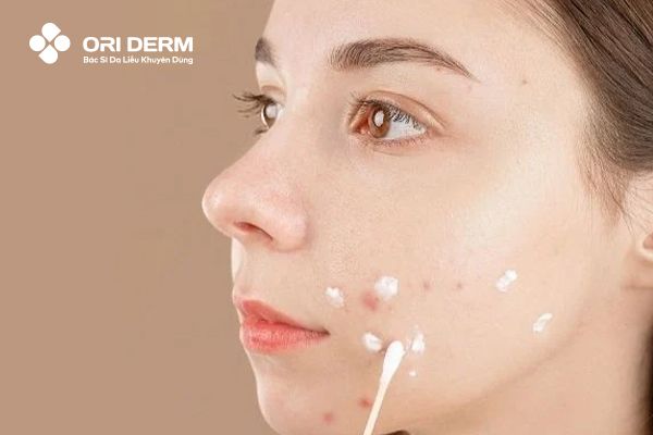 Các thành phần thường có trong thuốc đẩy mụn ẩn