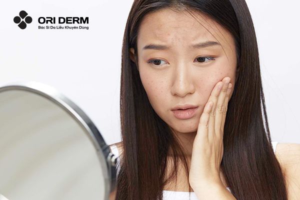 Mụn Ẩn: Nguyên Nhân, Cách Nhận Biết Và Phương Pháp Điều Trị Hiệu Quả