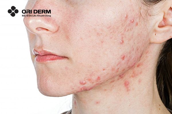 Mụn Ở Quai Hàm: Dấu Hiệu Cảnh Báo Và Phương Pháp Điều Trị Hiệu Quả