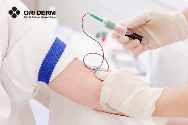 Điều trị sẹo đáy nhọn bằng PRP