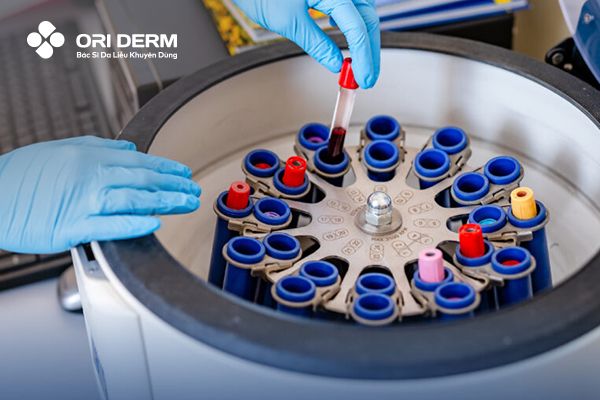 PRP - Huyết tương giàu tiểu cầu