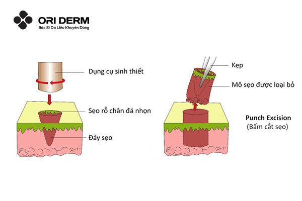 Punch Excision (Cắt Bỏ Sẹo)