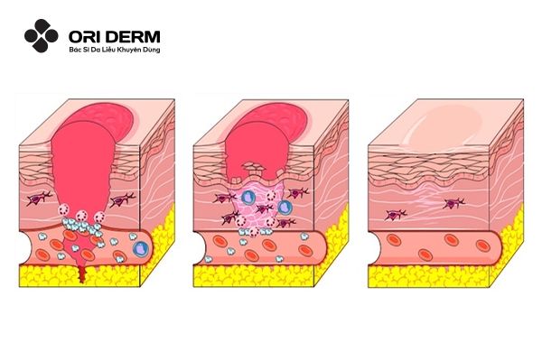 Sẹo rỗ hình thành như thế nào?