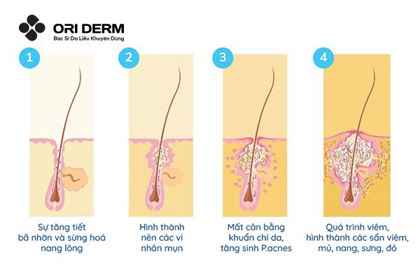 Quá trình phát triển của mụn viêm ở má