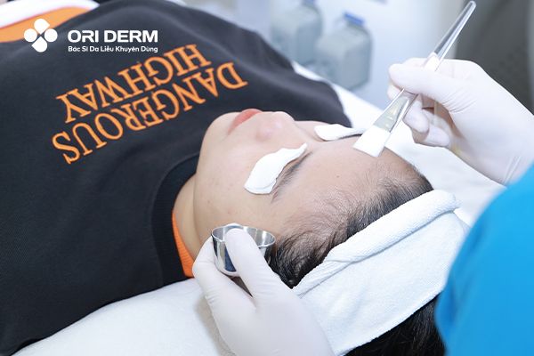 Quy trình peel da trị sẹo rỗ