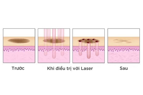 Quy trình trị thâm mụn bằng laser