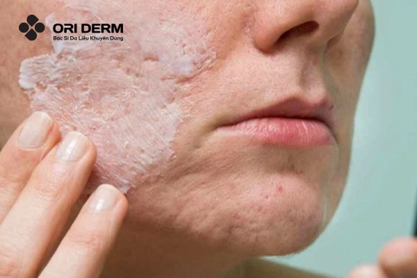 Retinol có trị sẹo rỗ không?