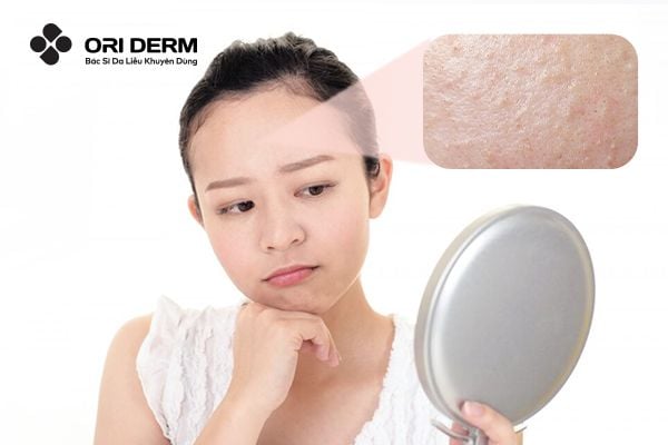 Mụn Ẩn Có Tự Hết Được Không? Cách Điều Trị Mụn Ẩn