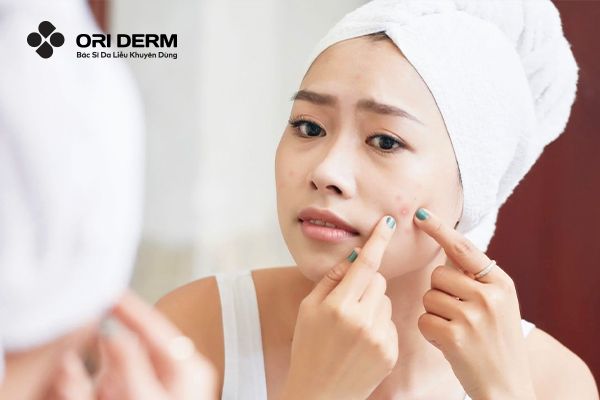 Vì Sao Nổi Mụn Ở Má? Hướng Dẫn Điều Trị Và Phòng Ngừa Nổi Mụn Ở Má