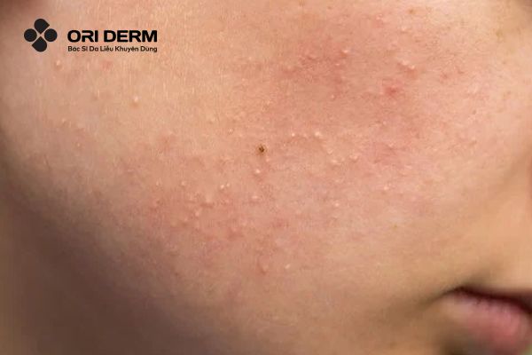 Đặc điểm, vị trí và quá trình phát triển của mụn ẩn