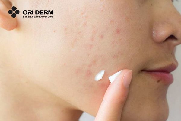 Điều trị vết thâm mụn bằng sản phẩm đặc trị