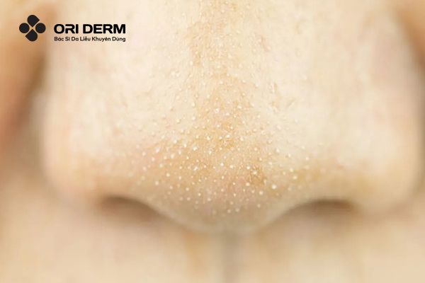 Dấu hiệu và triệu chứng nhận biết mụn ẩn đầu trắng