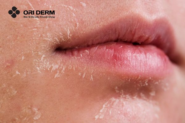 Những rủi ro khi peel da trong lúc dùng retinol