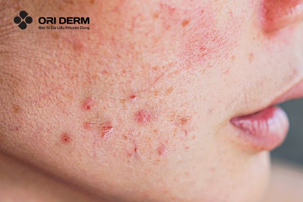 Những sai lầm cần tránh khi sử dụng Retinol