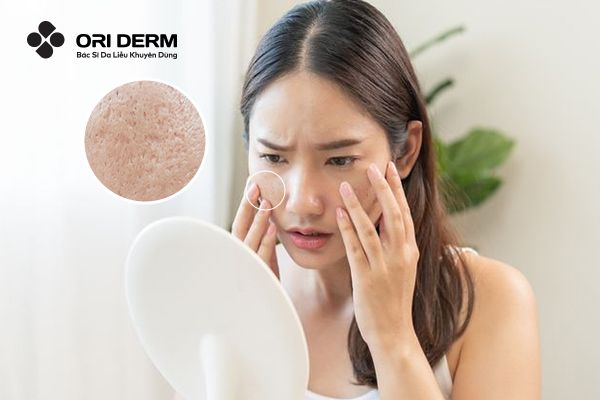 Sẹo lõm có tự đầy không?