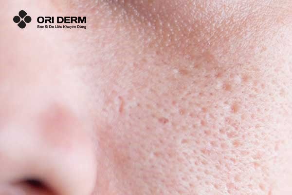 Vậy sẹo lõm là gì?