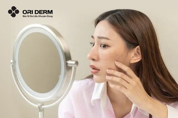 Vậy sẹo mụn có tự hết không?