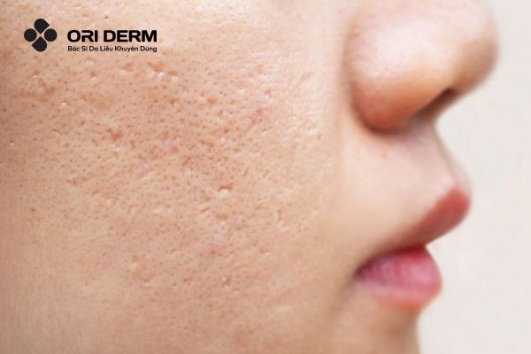 Sẹo đáy nhọn là gì?