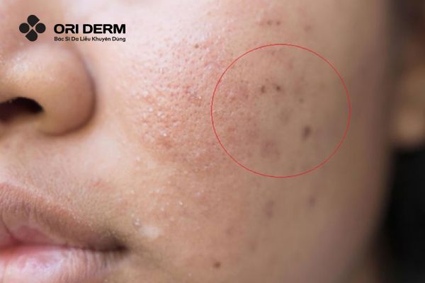 Sẹo thâm là gì?