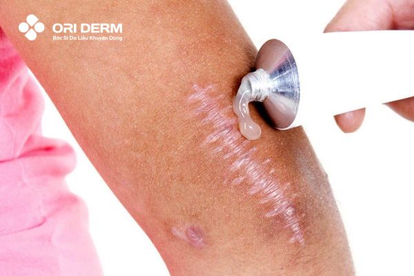 Sử dụng kem trị sẹo sau phẫu thuật