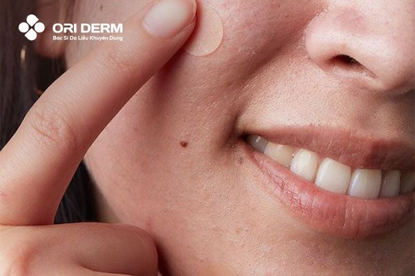 Sử dụng miếng dán trị mụn ẩn