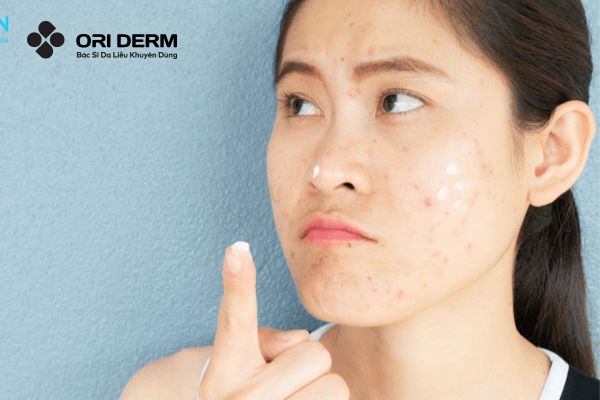 Sử dụng sản phẩm kem trị mụn viêm trên mũi