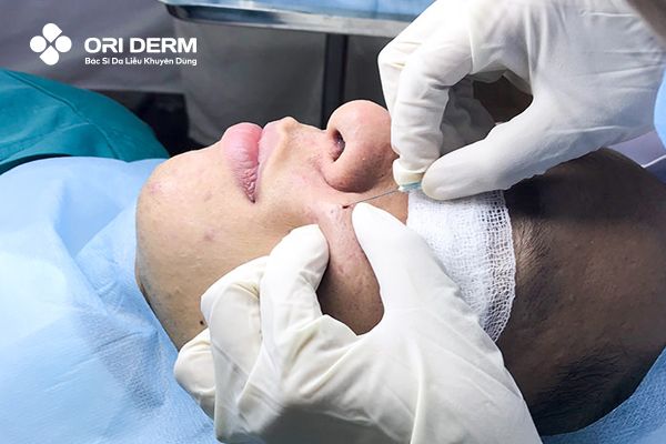 Subcision (Cắt đáy sẹo)