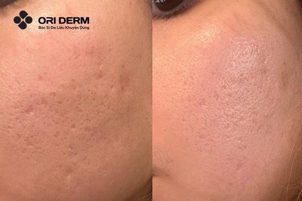 Tác dụng của lăn kim với làn da