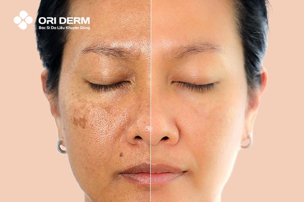 Tác dụng của Retinol đối với làn da